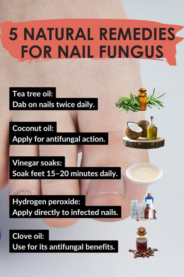 5 Natural Remedies for Nail Fungus
